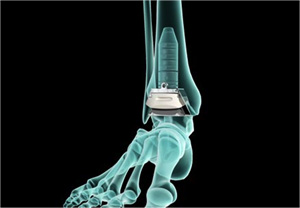 INBONE® Total Ankle System 